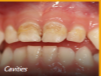 Early childhood caries prevention