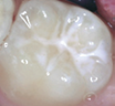Tooth after sealant showing smooth protected surface