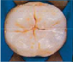 Tooth before sealant showing deep grooves and pits