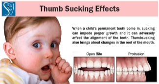 Thumb sucking effects on teeth
